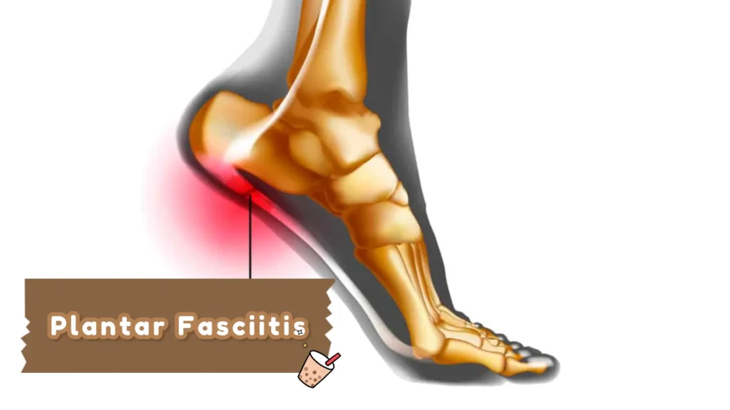 shoes for Plantar Fasciitis